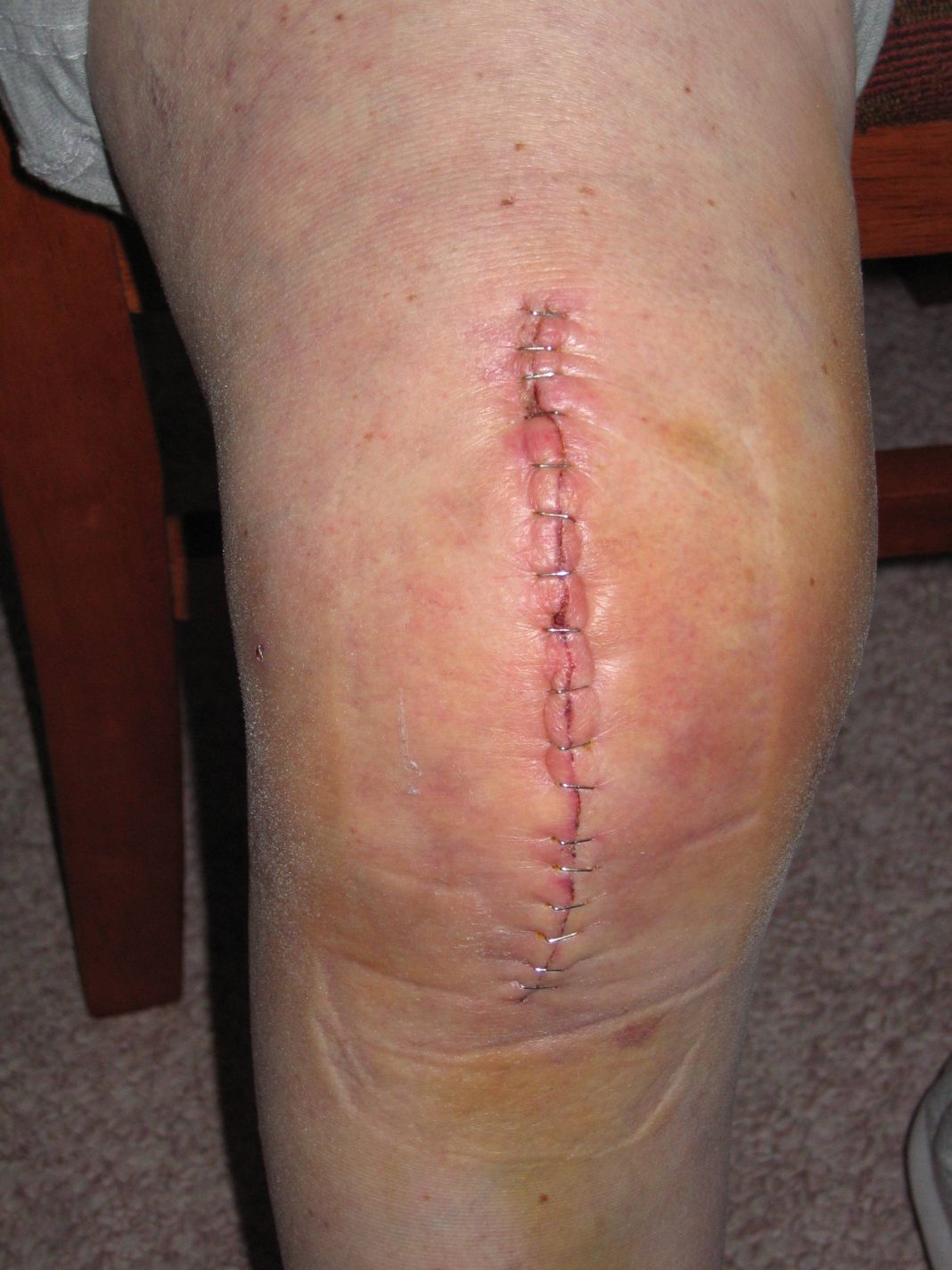Knee Replacemen
