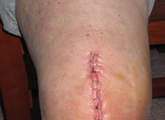 Why Hospital Beds are Ideal for Home Use After Knee Replacement: Advantages and Insights Knee Replacemen
